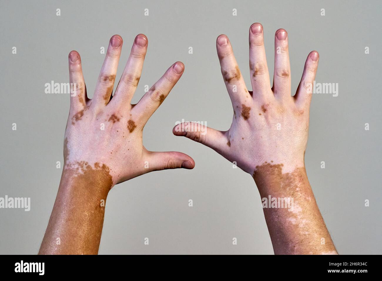 Vitiligo skin disease on male hands Stock Photo
