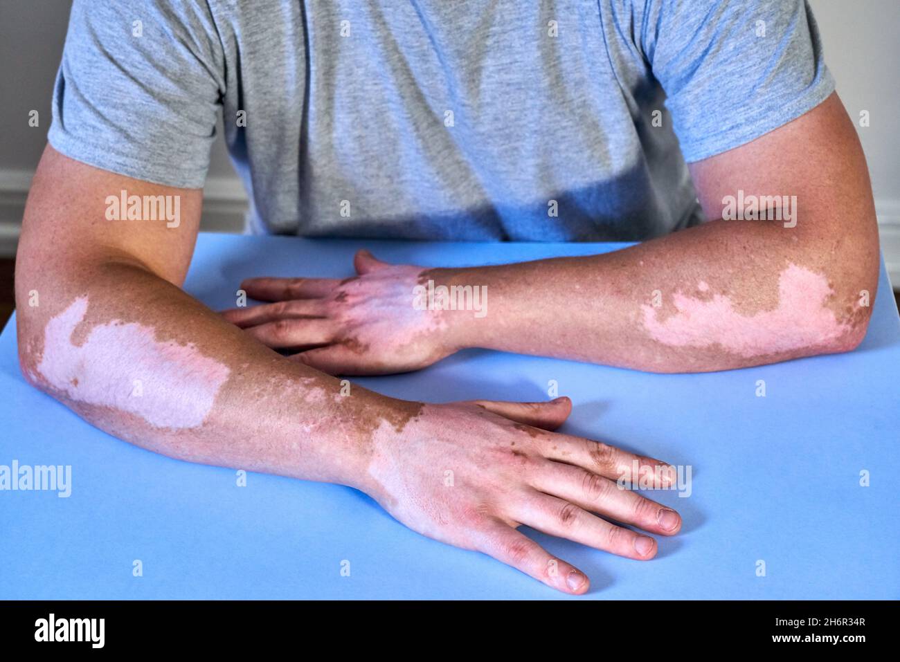 Vitiligo skin disease on male hands Stock Photo