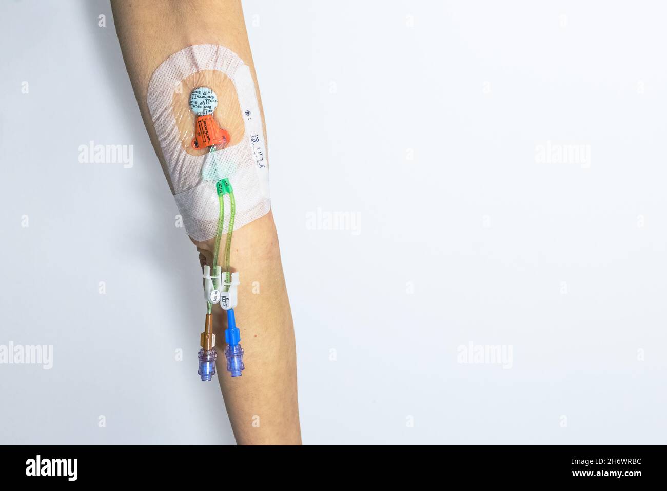 PICC line (peripherally inserted central catheter line) inserted in arm to administer chemotherapy treatment or other medicines Stock Photo