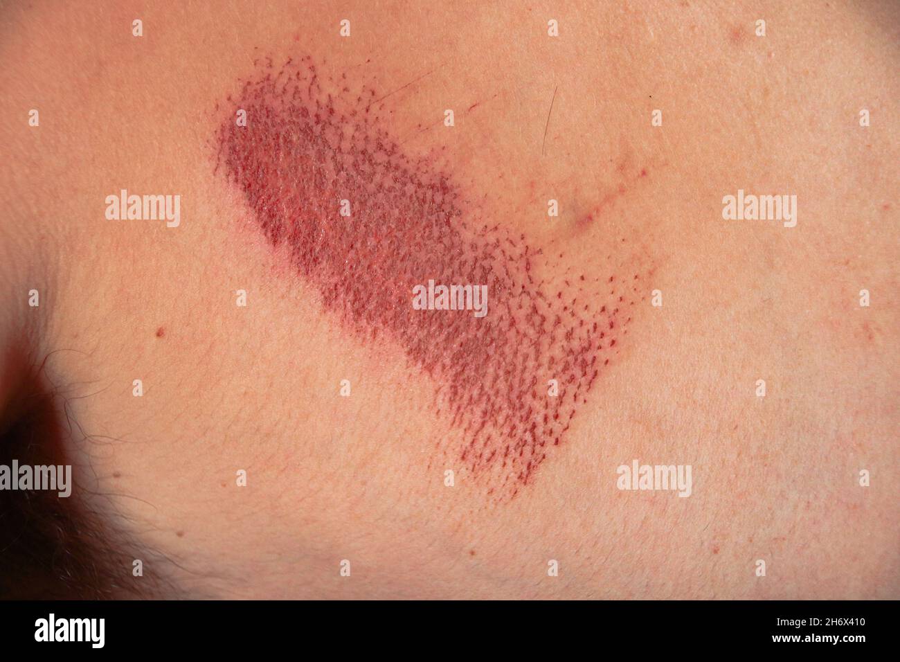 Close up of an abrasion wound in Caucasian skin Stock Photo