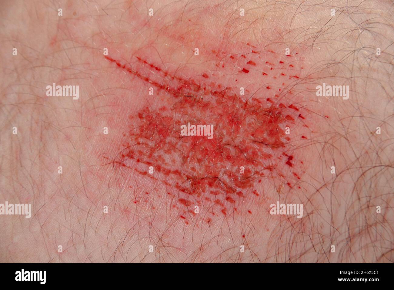 Close up of an abrasion wound in Caucasian skin Stock Photo