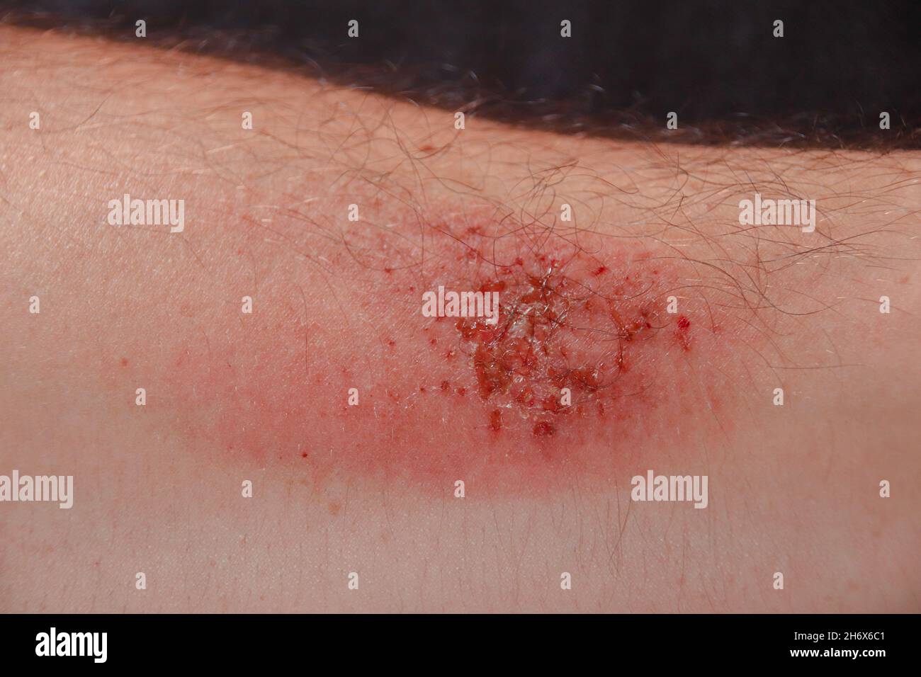 Close up of a well healing abrasion wound injury in Caucasian skin