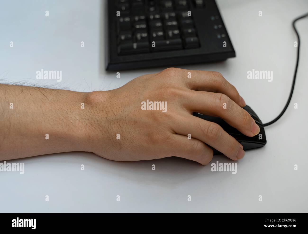 Computer Mouse Cyst Ganglion cyst on man's hand. Hand holding computer mouse Stock Photo ...
