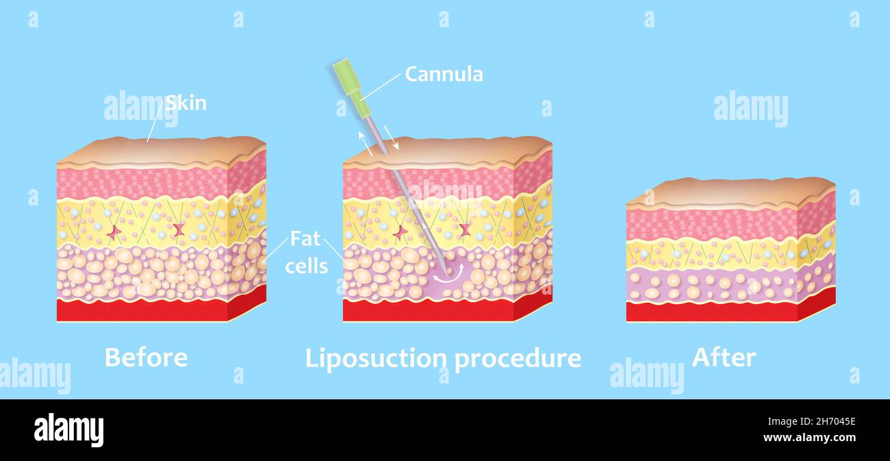 Mechanism of liposuction. Suction-assisted liposuction. Hollow tube or cannula, which is inserted through a small incision in the skin in order to fat suctioned out of the body Stock Photo