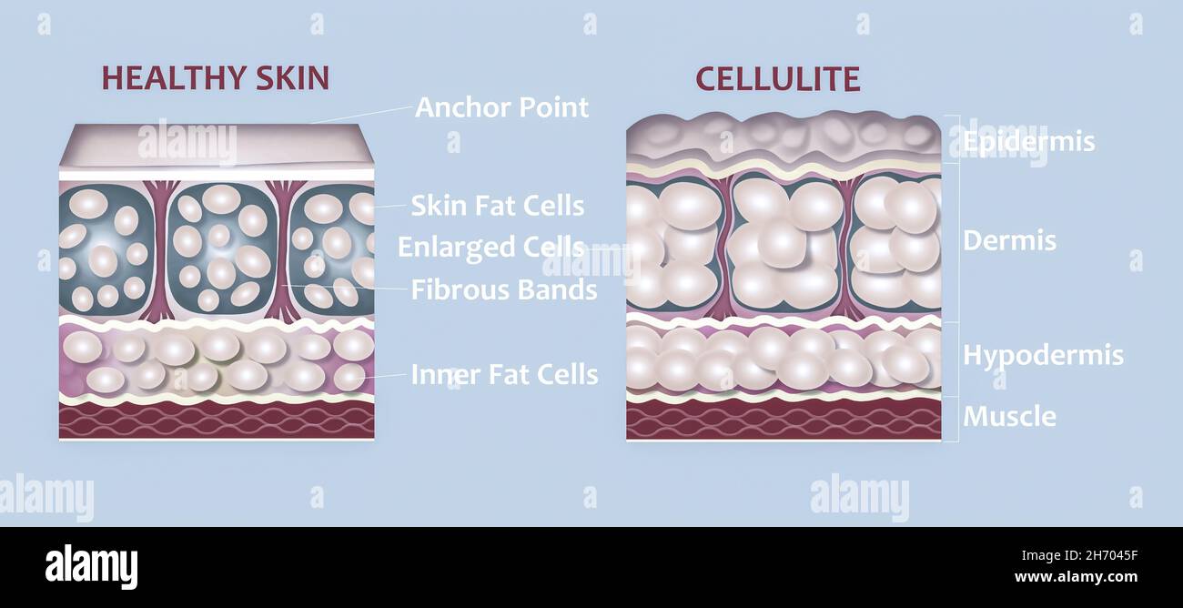 Forming of underskin cellulite illustration. Structure of normal ...