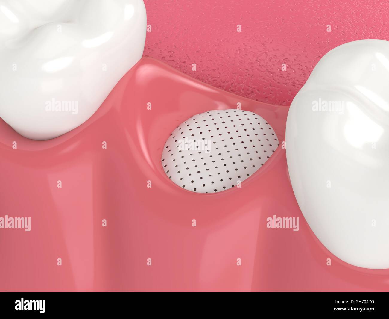3D render of dental bone grafting with membrane Stock Photo Alamy