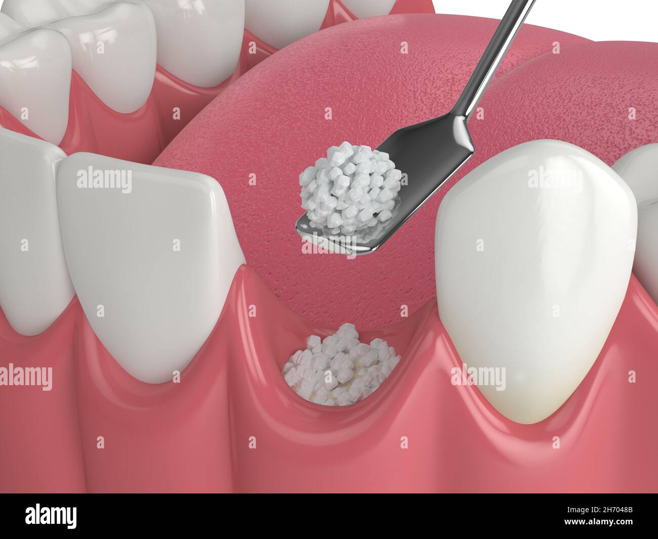 3D render of dental bone grafting with dental bone biomaterial over