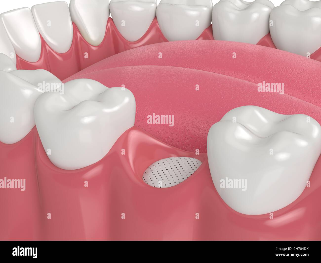 3D render of dental bone grafting with membrane Stock Photo Alamy