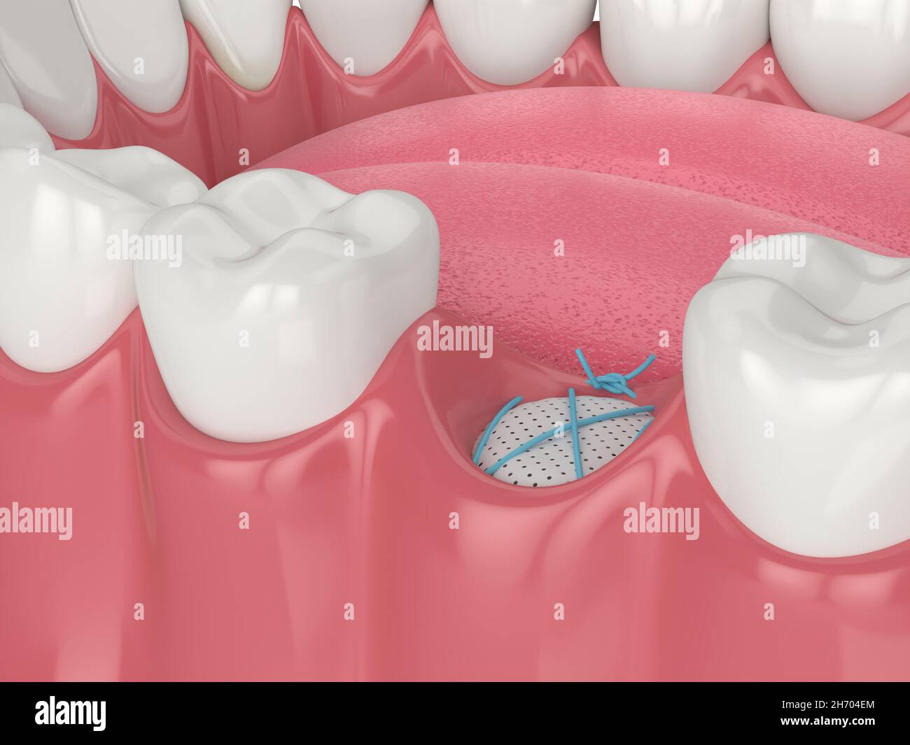 3D render of dental bone grafting with membrane and sutures Stock Photo