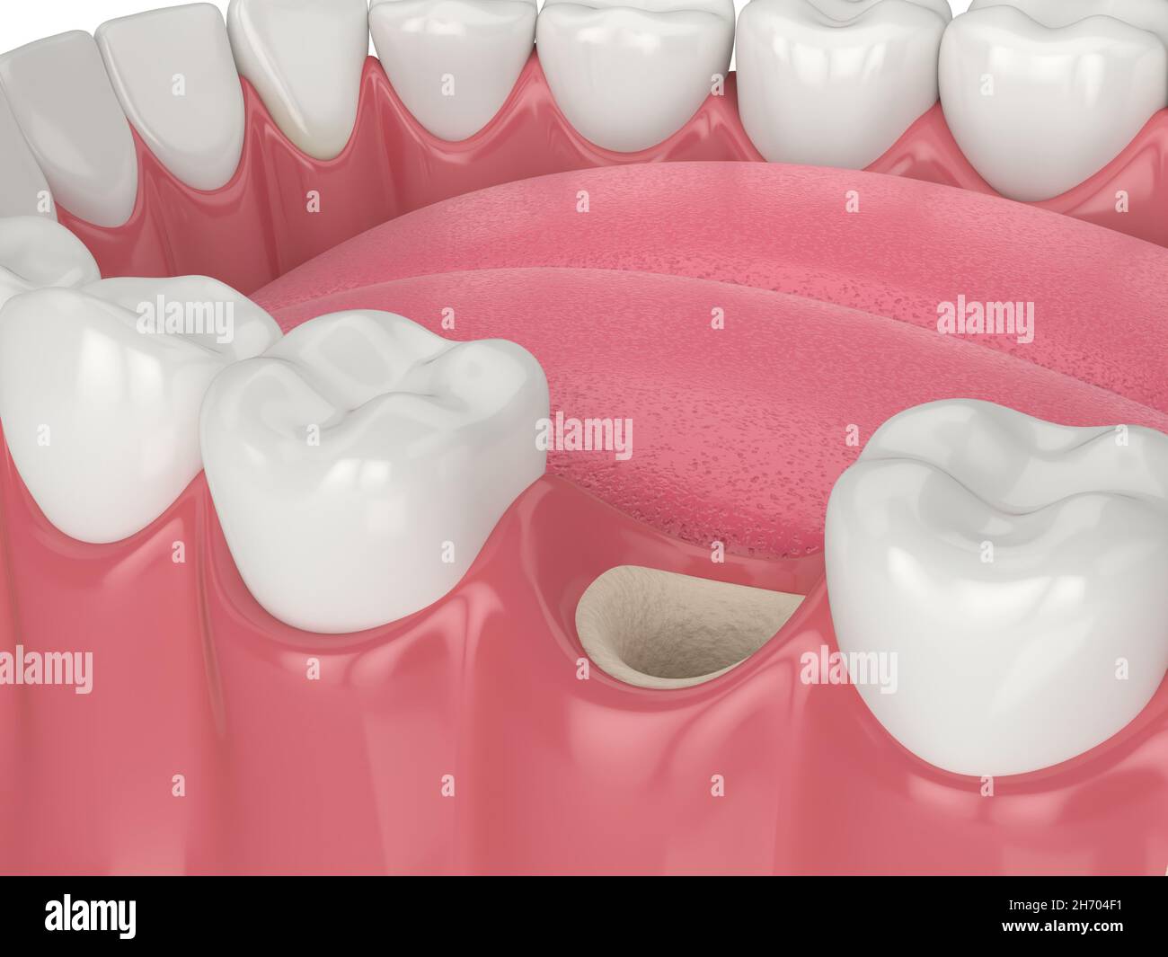Empty Socket 3D render of jaw with empty socket ready to dental bone grafting Stock ...
