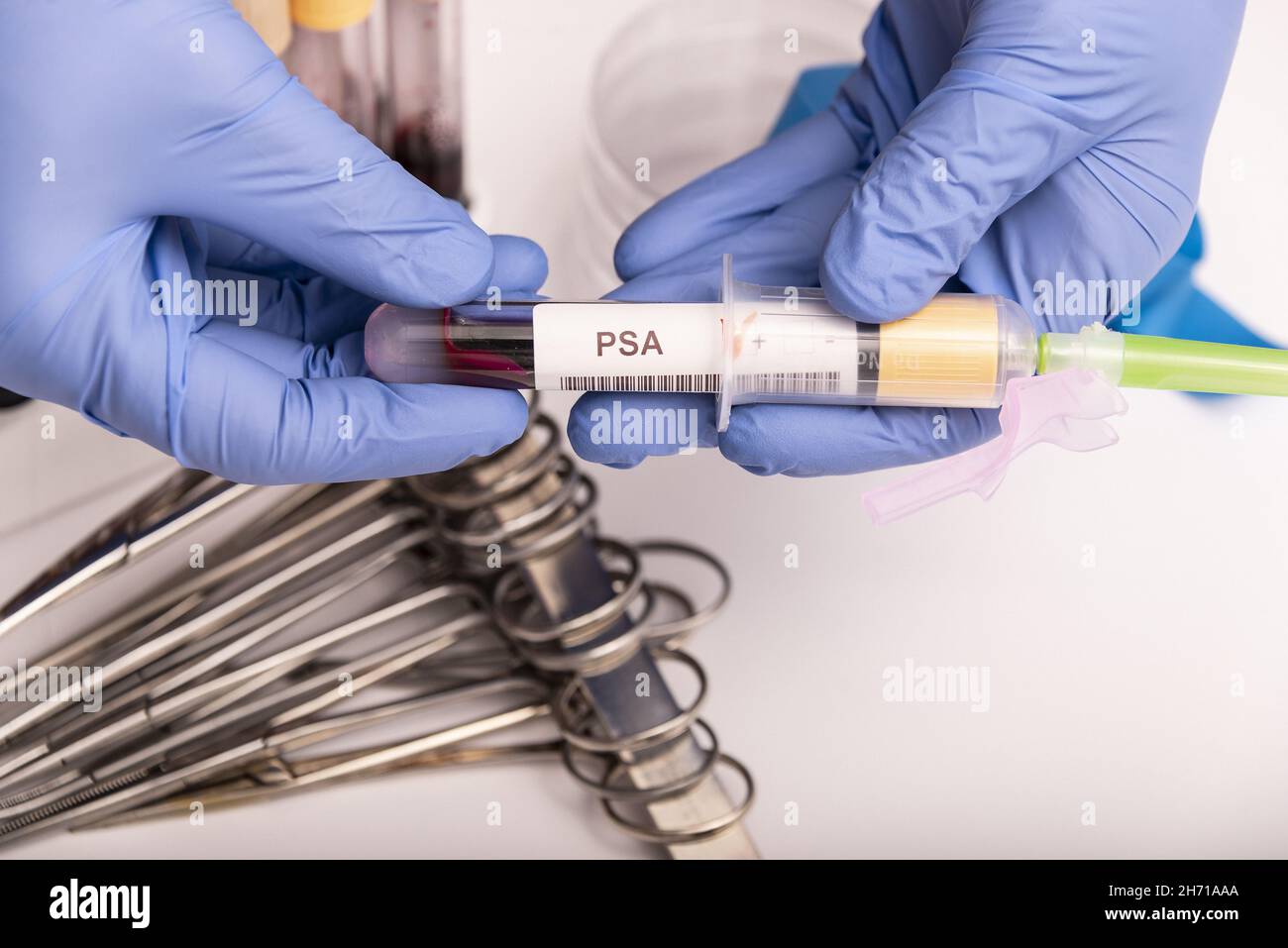 Blood sample with abnormal high PSA test result Stock Photo Alamy