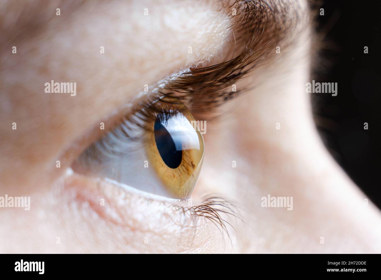 Macro photo of the human eye with corneal disease keratoconus Stock Photo
