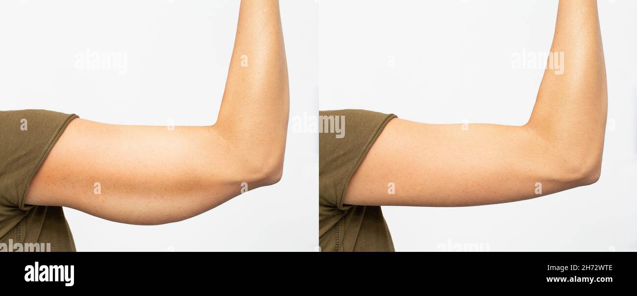 Before and after excess skin removal under the arm Stock Photo Alamy