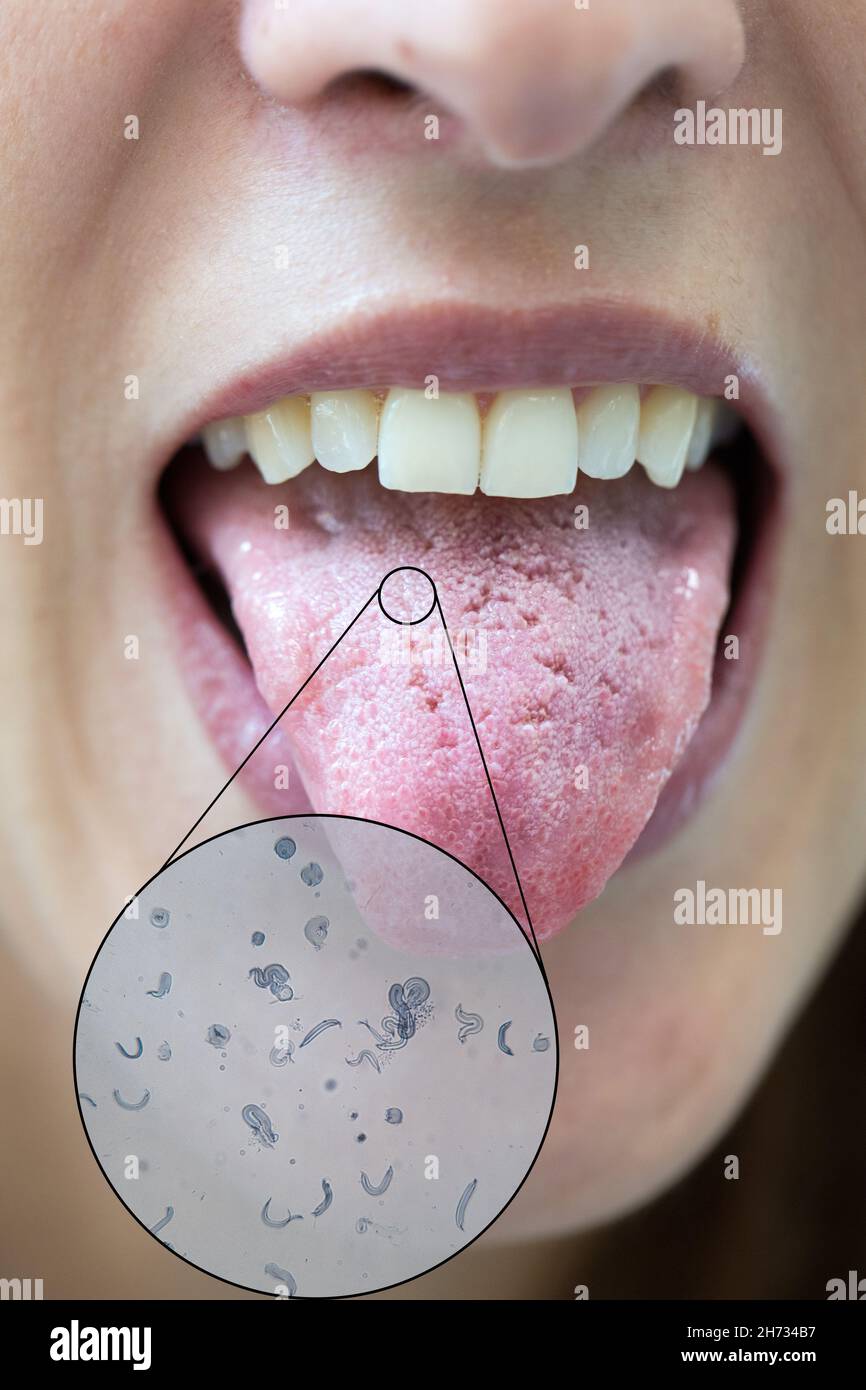 Tongue with cracks and bacterial infection with microscopic view Stock Photo