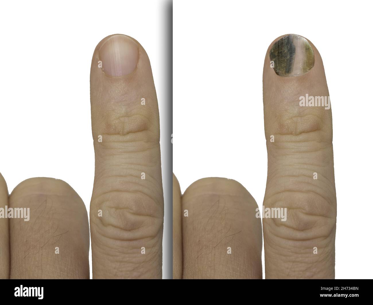 Before and after successful treatment for a fungal infection on