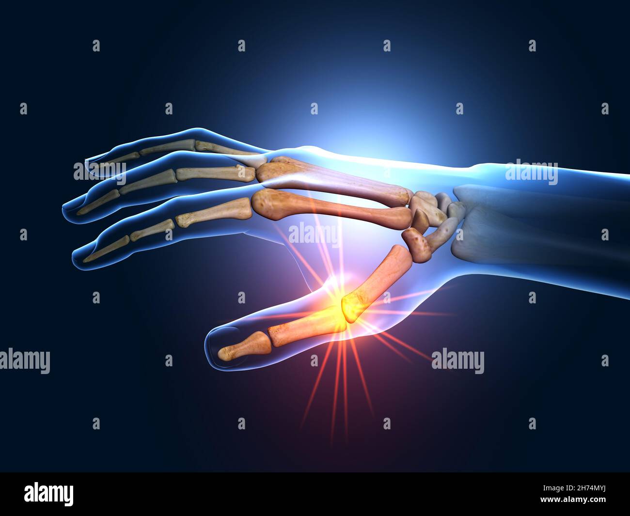 3D illustraion showing painful hand joints Stock Photo