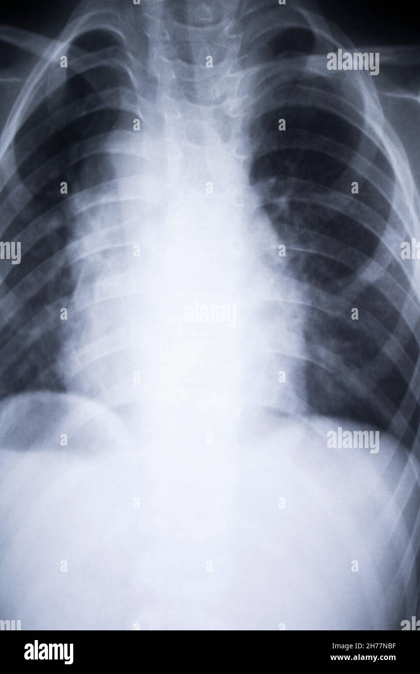 x-ray imagefrom the human chest and pacemaker Stock Photo - Alamy