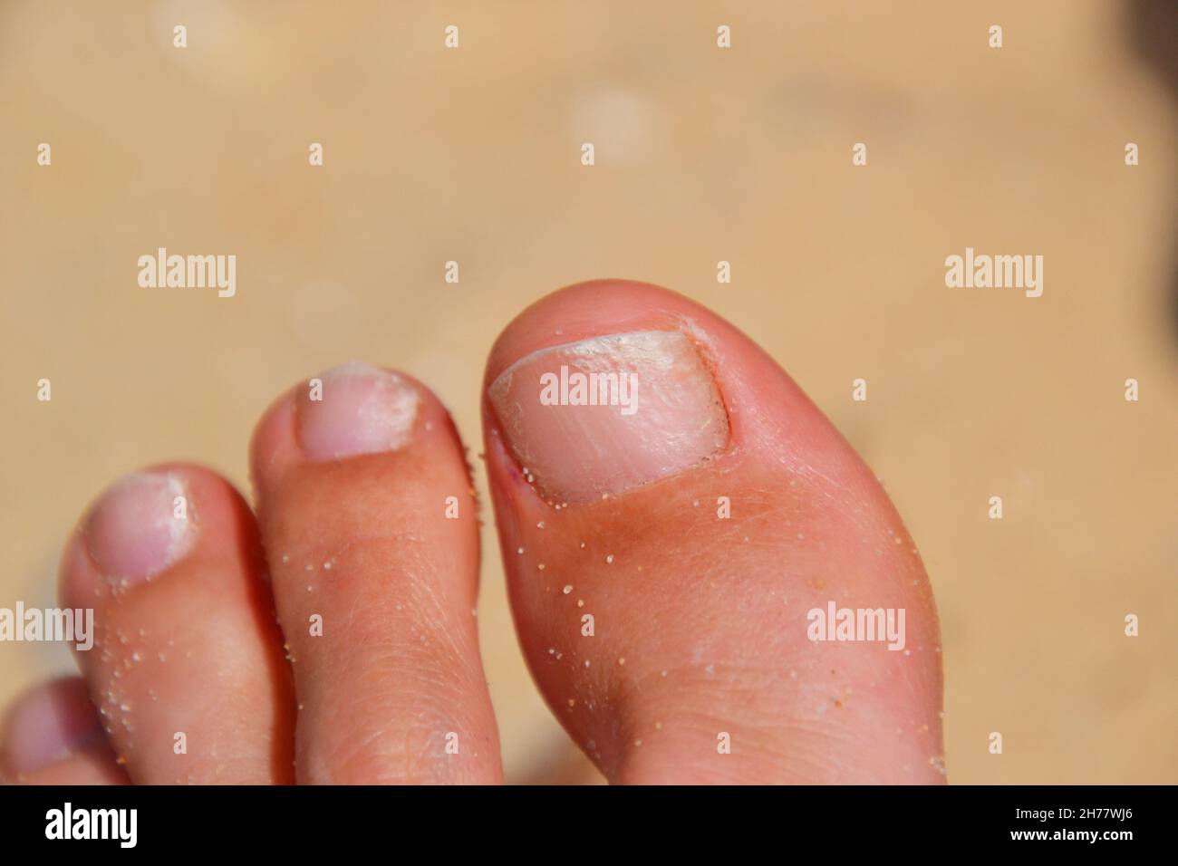 Fungal Nail High Resolution Stock Photography And Images Alamy
