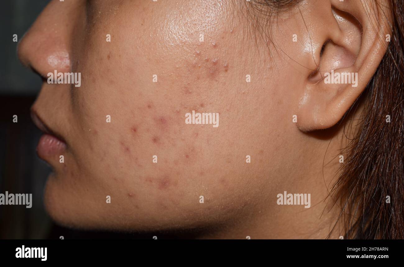 Acne , black spots and scars on face of Asian young woman. Stock Photo