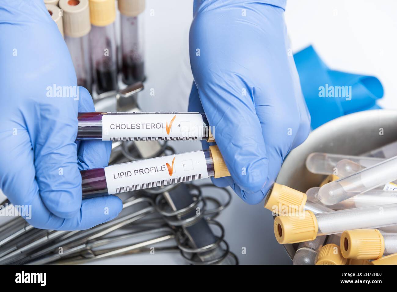 Blood sample for cholesterol testing. medical technology Stock Photo