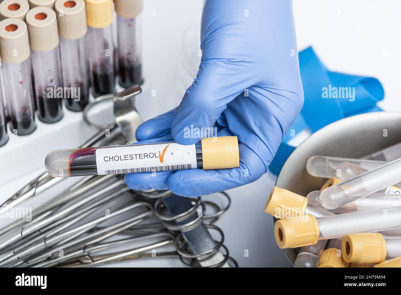 Blood sample tube with abnormal high cholesterol test result Stock