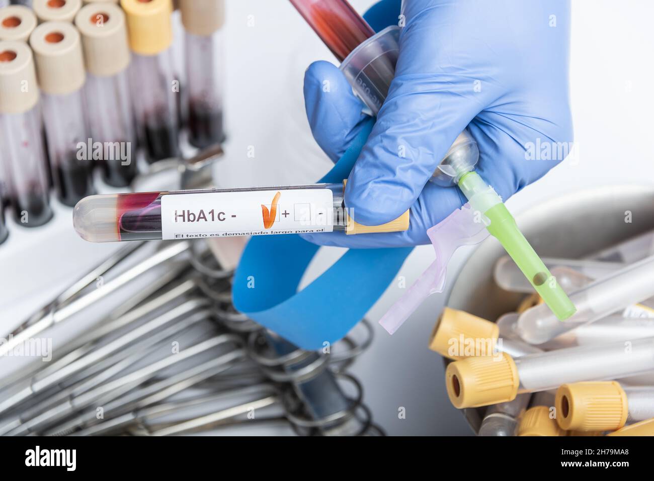 Blood sample for HbA1c test, diabetes diagnosis Stock Photo Alamy