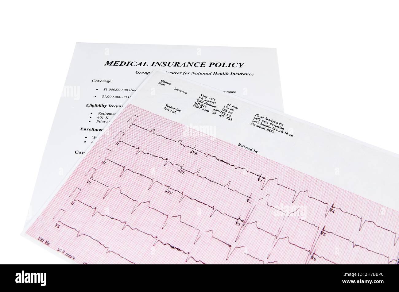 Ecocardiography report (ECG) showing irregular heartbeat with a medical insurance policy underneath it isolated on white Stock Photo