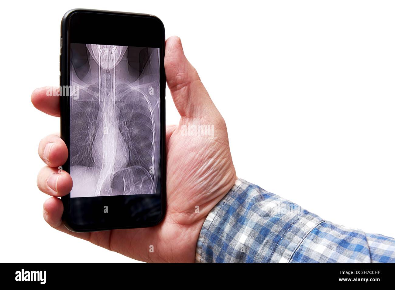 Man's hand holding a mobile phone with a CT scan image of lungs. Pneumonia and disease diagnosis Stock Photo