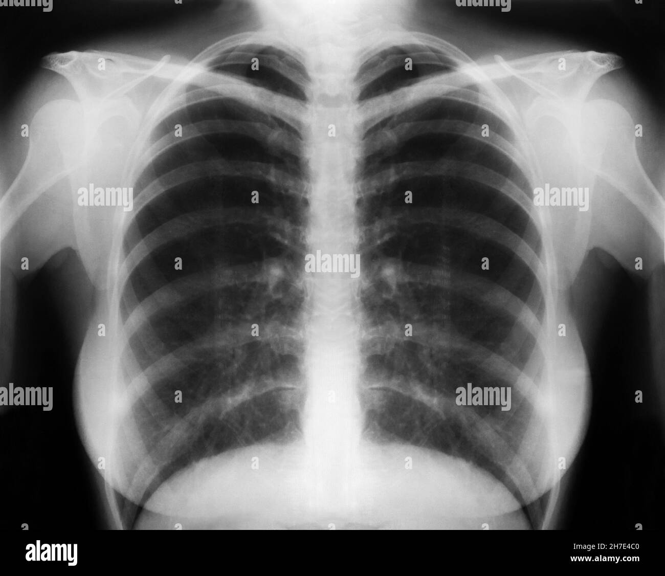 X Ray Of Lungs With Asthma