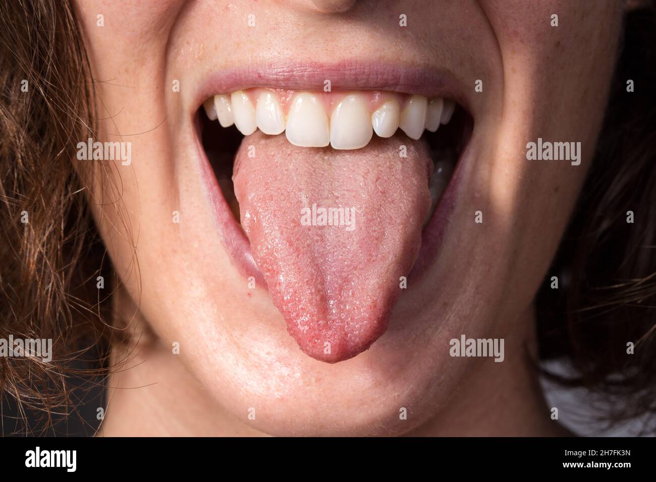 Girl on a check visit to detect candidiasis on tongue Stock Photo