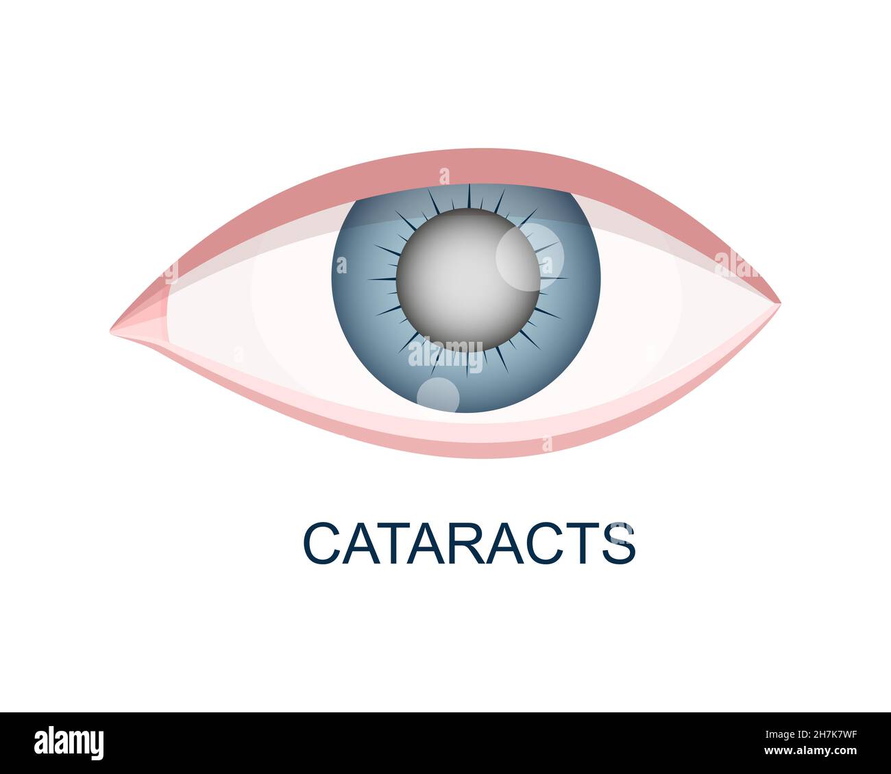 Cataract eye close up view. Eyeball with cloudy lens. Anatomically accurate human organ of