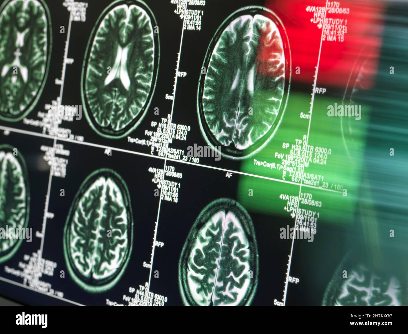 Medical scan of MRI in neurology clinic Stock Photo