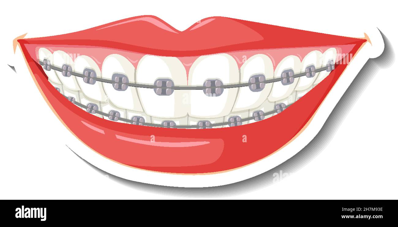 Teeth with braces on white background illustration Stock Vector Image ...