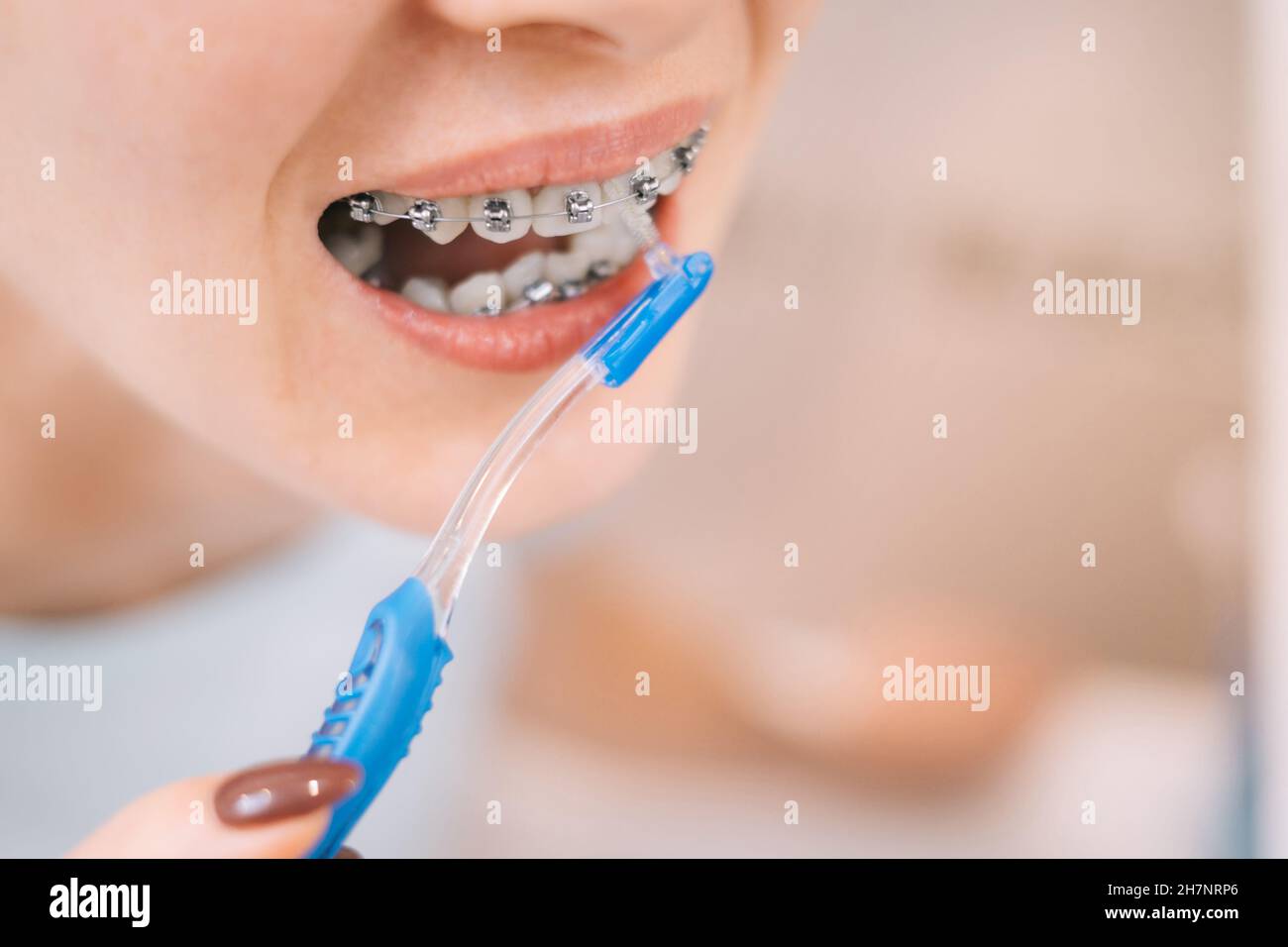 можно чистить брекеты электрической зубной щеткой. ирригатор для зубов. How to polish brackets. щетка для чистки зубов с брекетами. стоматологические брекеты.