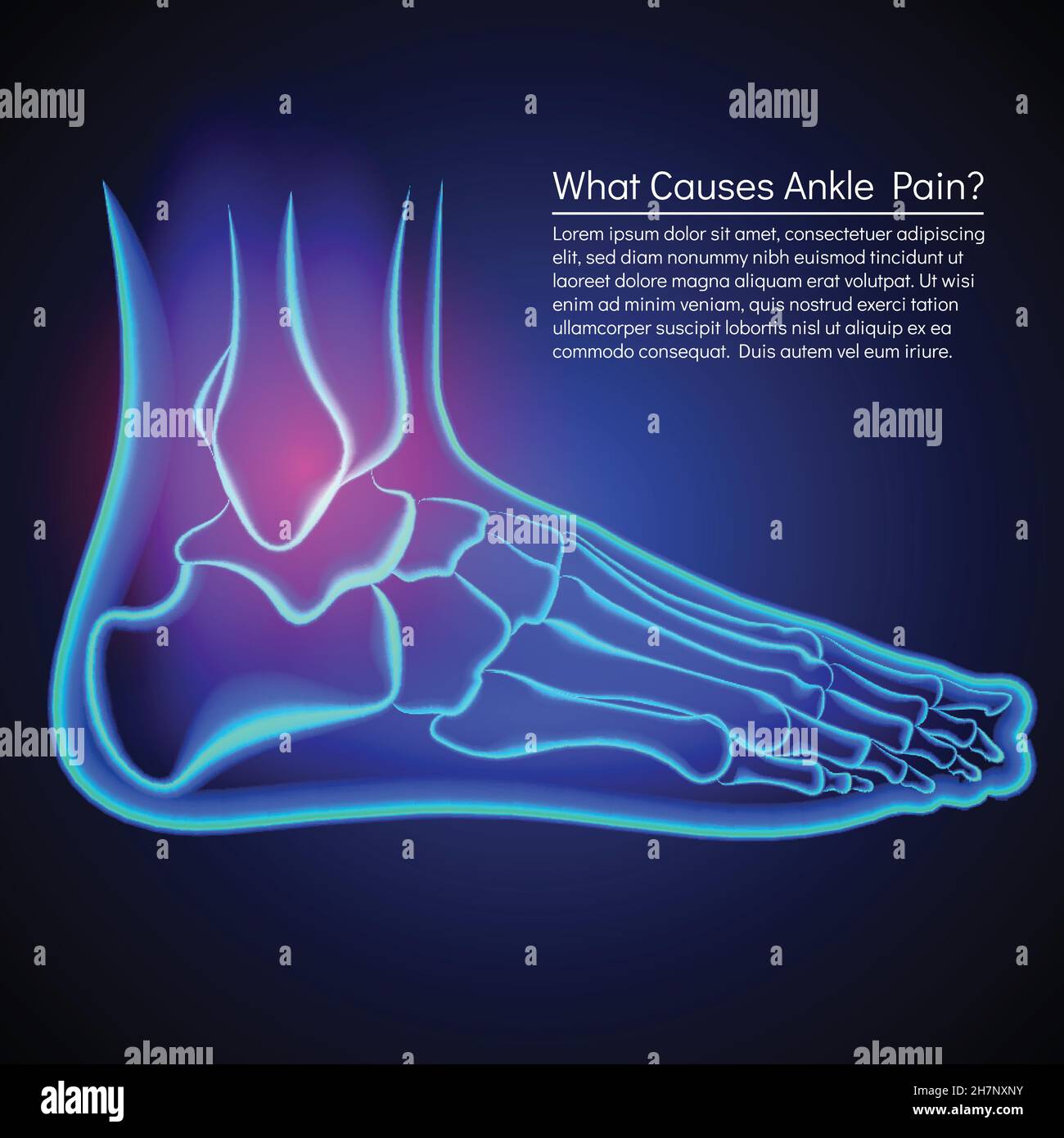 A broken ankle x-ray. Anatomy of the ankle. Pain in ankle. Stock Vector