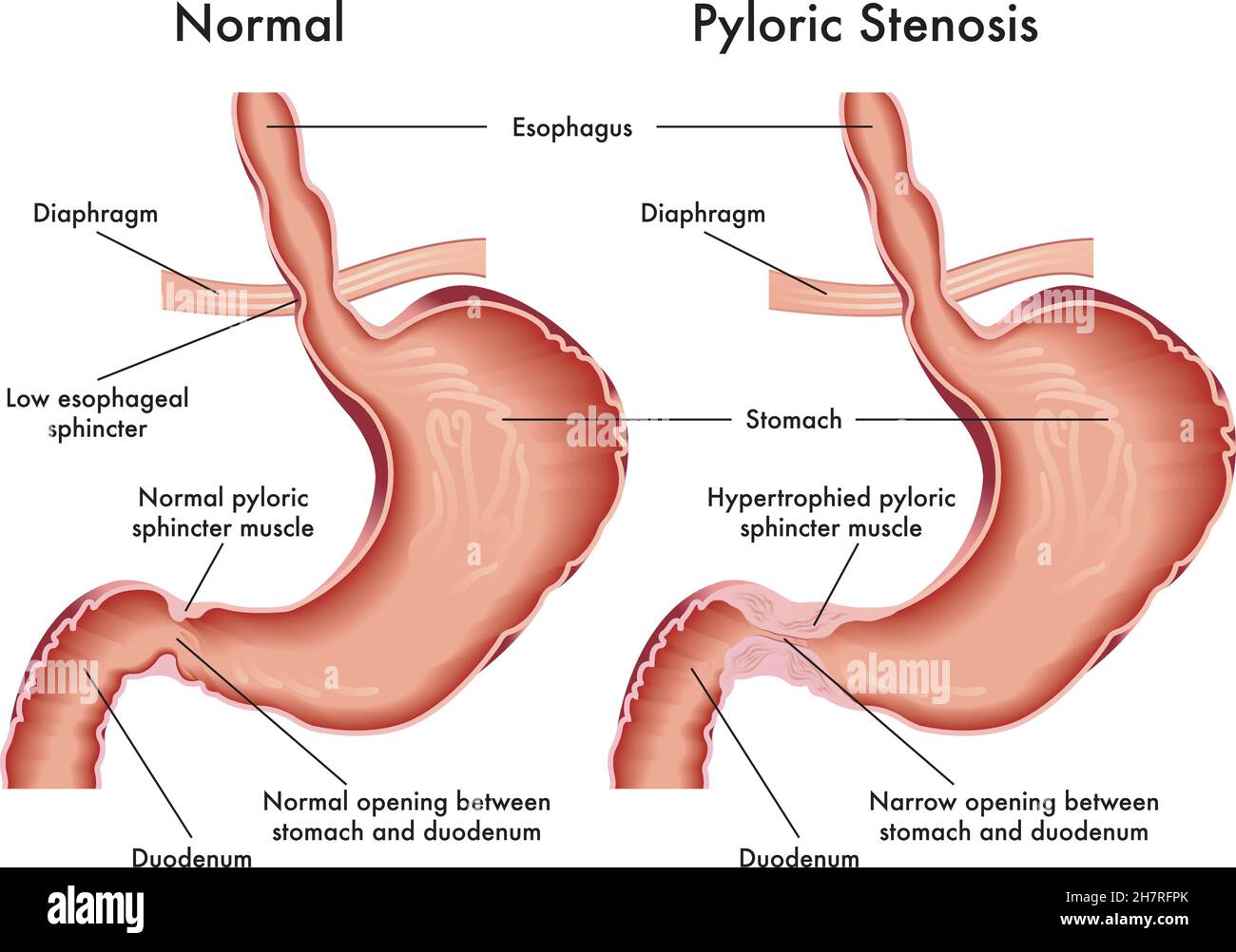 Medical illustration of symptoms of pyloric stenosis. Stock Vector