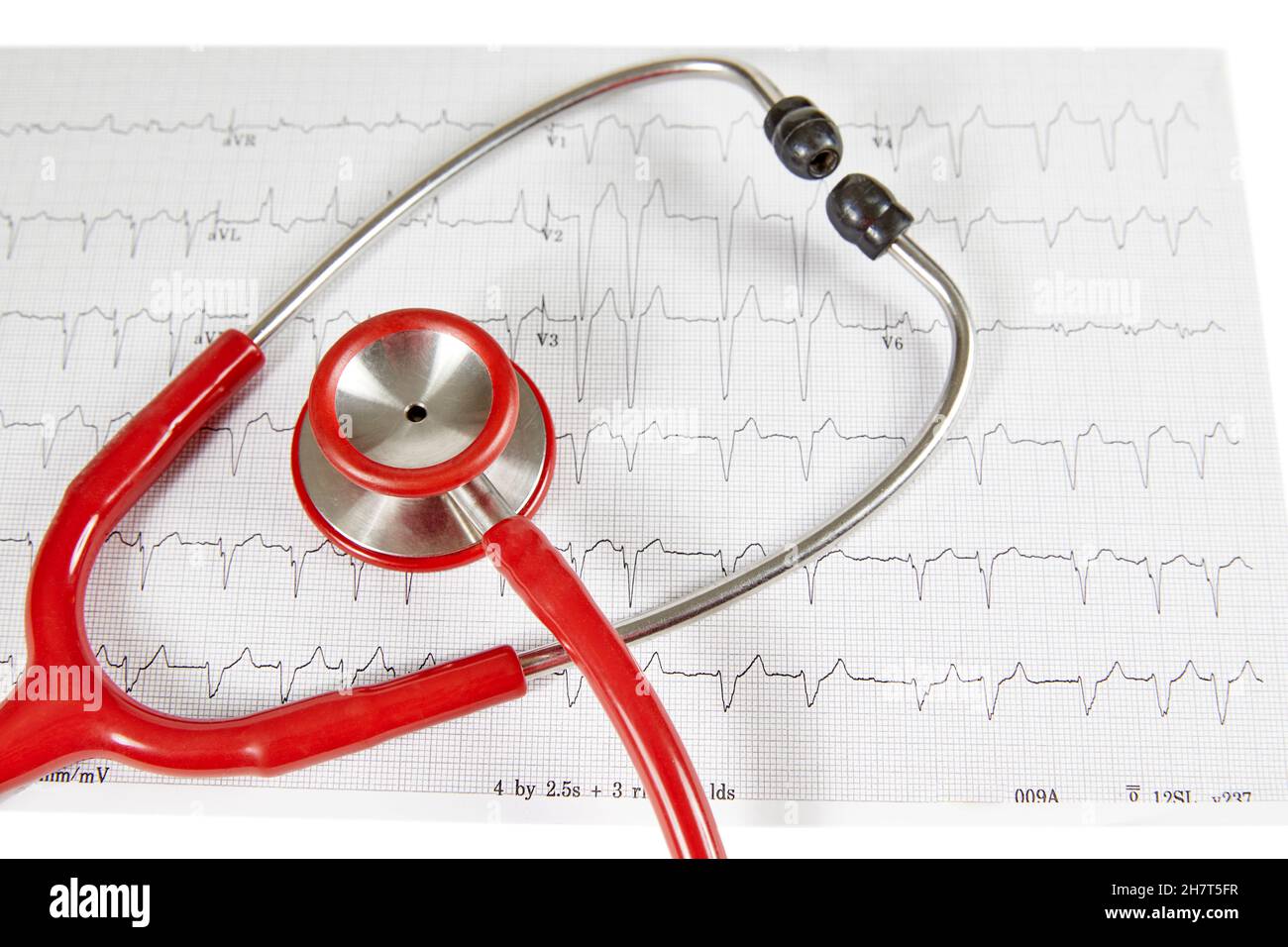 Ecocardiography report (ECG) showing irregular heartbeat with  a red stethoscope on top of it Stock Photo