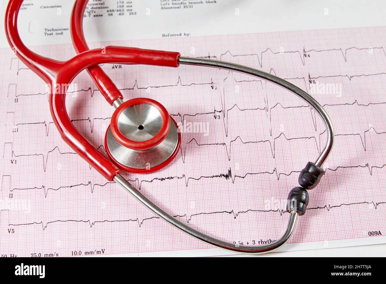 Ecocardiography report (ECG) showing irregular heartbeat with  a red stethoscope on top of it Stock Photo