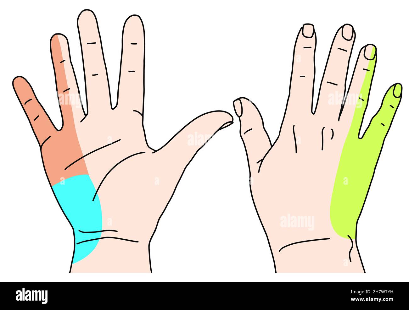 Scheme of numbness Tunnel syndrome of ulnar nerve. Doodle line drawing of damage area. Vector illustration Stock Vector