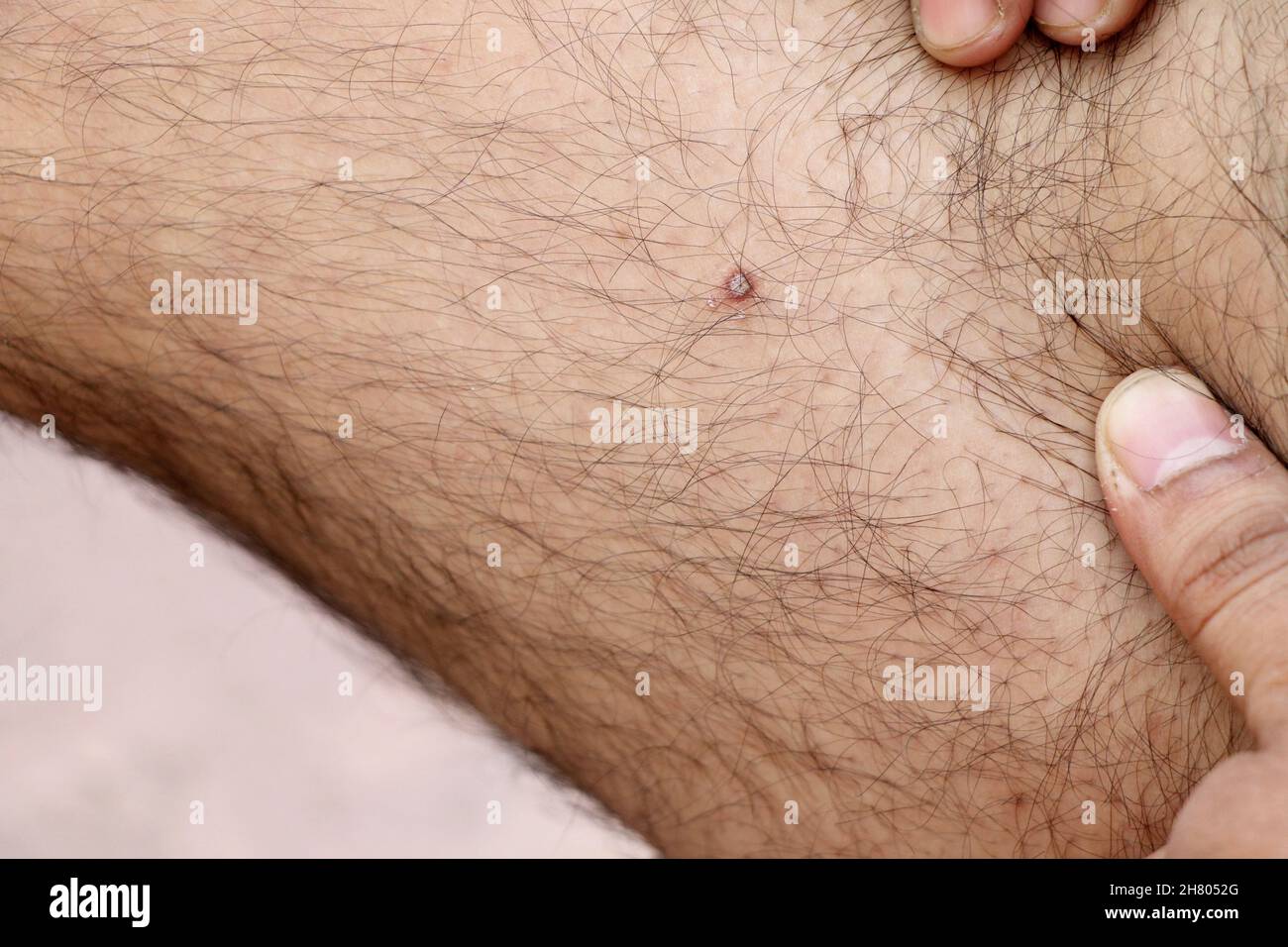 A closup of pimple on man's thigh Stock Photo