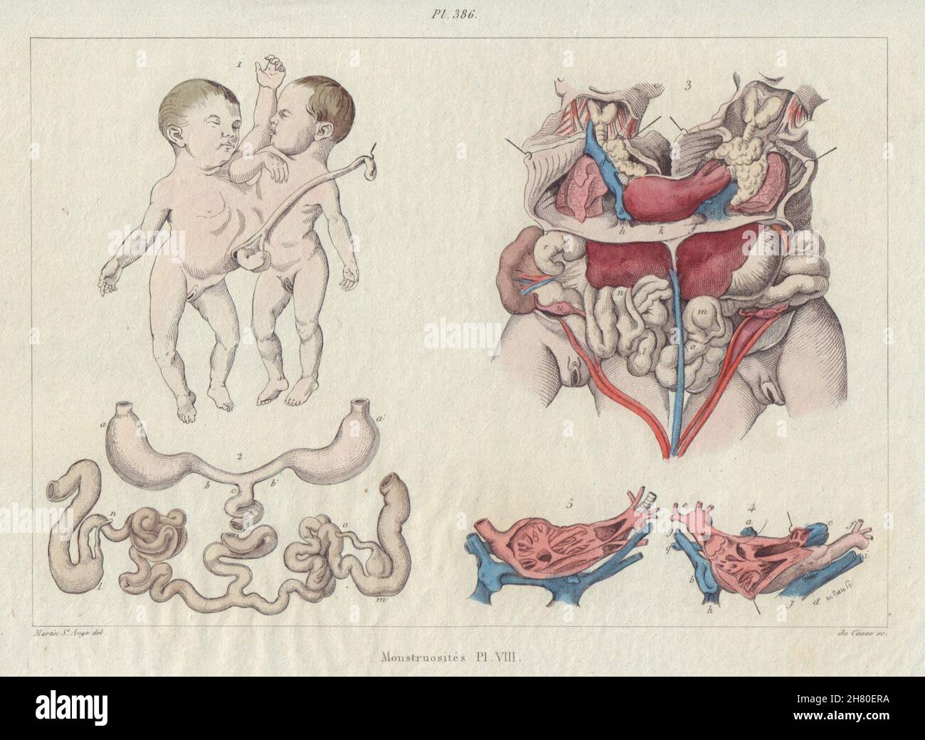 MUTATIONS. 'Monstruosités' Pl. VII. Conjoined twins 1833 old antique print Stock Photo