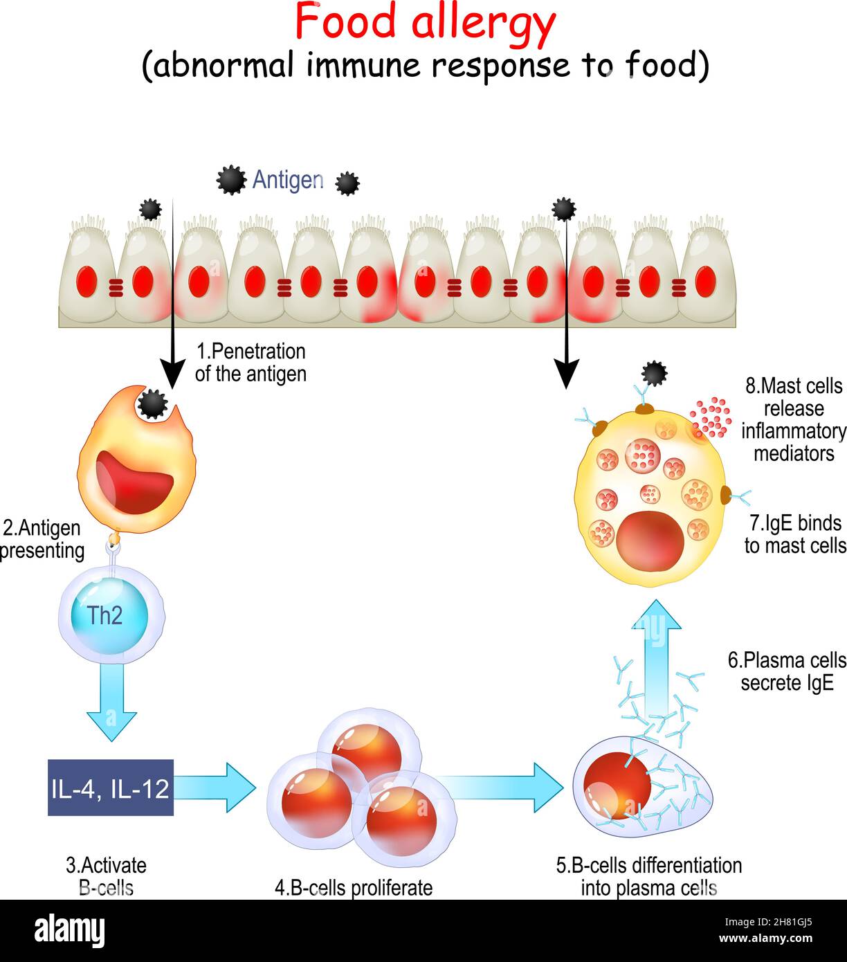 Food allergy. abnormal immune response to food. Reaction of immune system from Penetration of the antigen and B-cells Activation to IgE secretion and Stock Vector