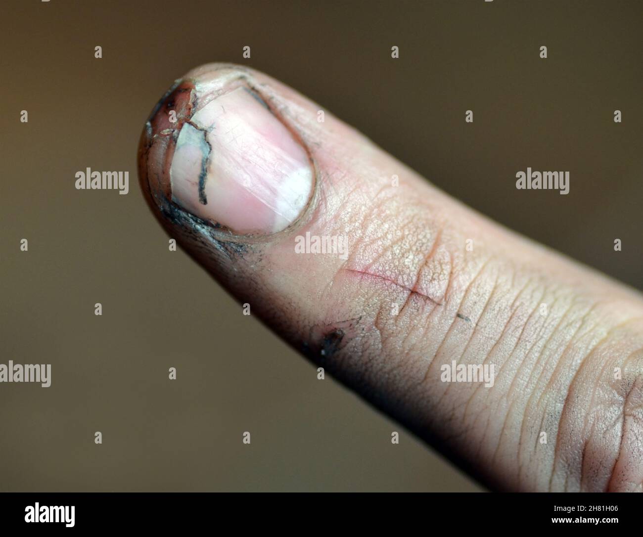 Open Wounded Finger Open wound scar hi-res stock photography and images - Alamy