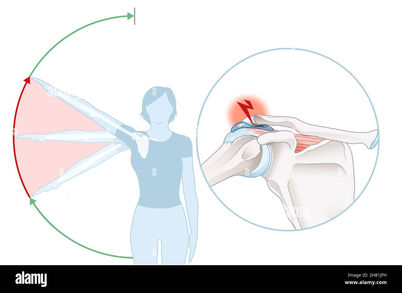Illustration showing shoulder impingement syndrome and painful arc Stock Photo