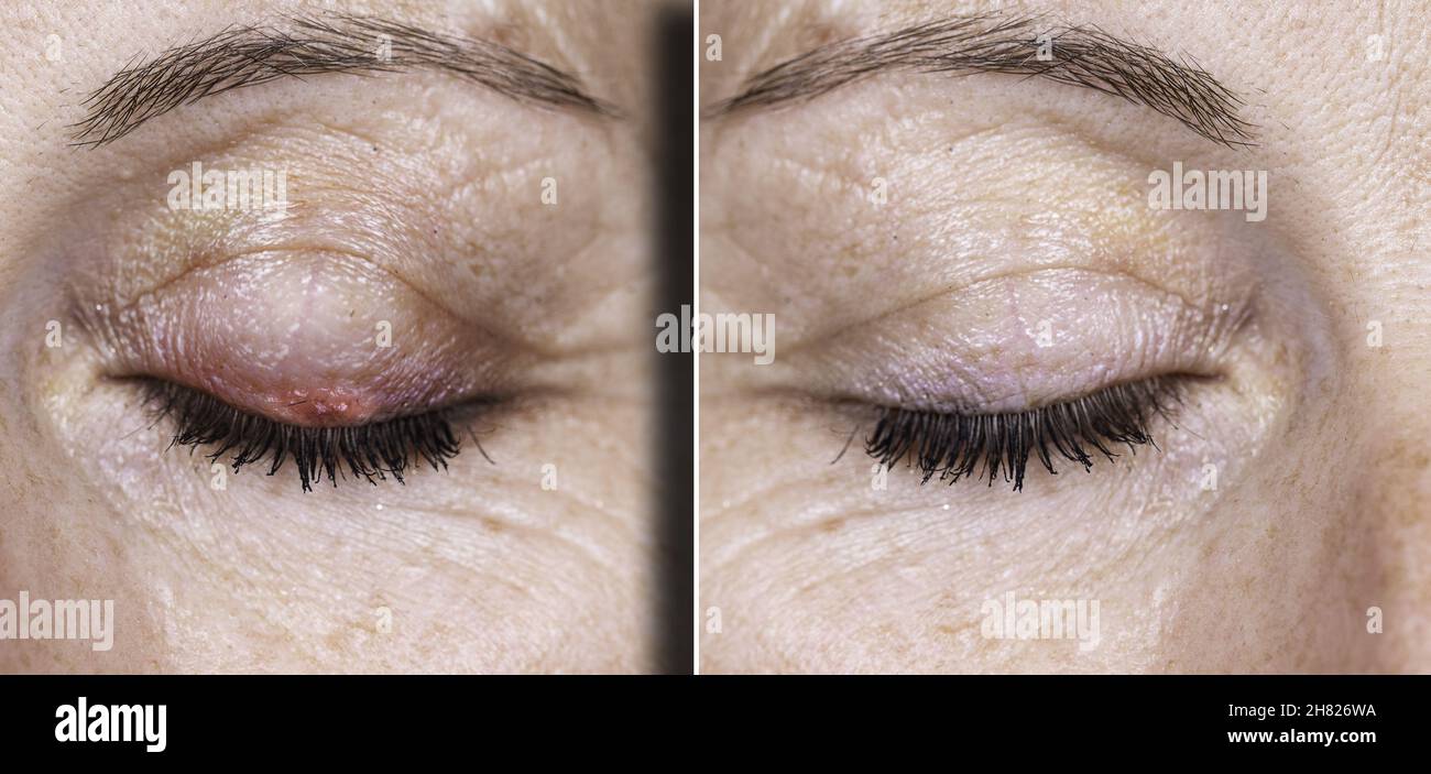 Female eyes showing a swollen red lump caused from a bacterial