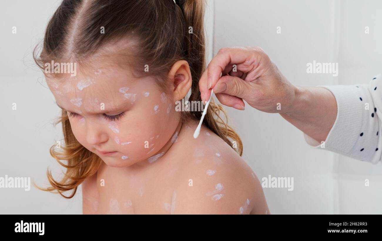 Little girl with chickenpox, antiseptic cream applied to rash. Female ...