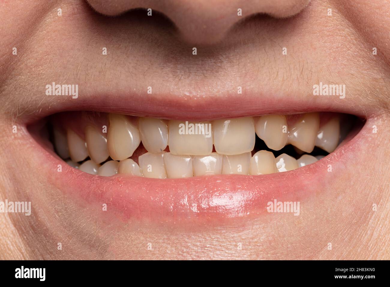 Teeth veneers yellow hires stock photography and images Alamy