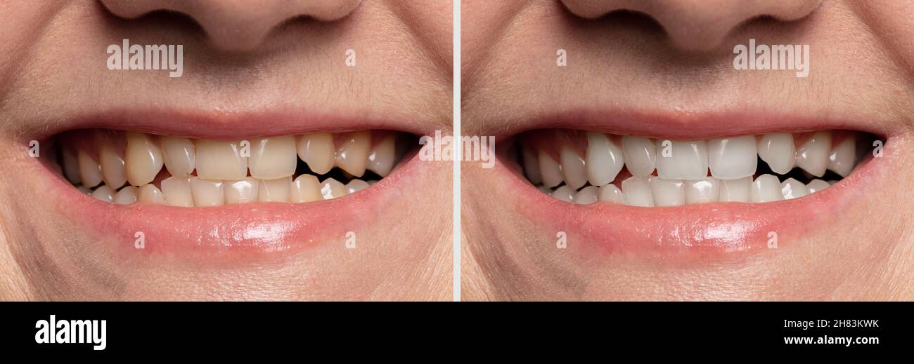 teeth whitening before and after close-up Stock Photo - Alamy