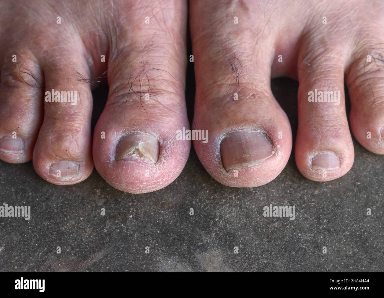 Skin split deals on toe
