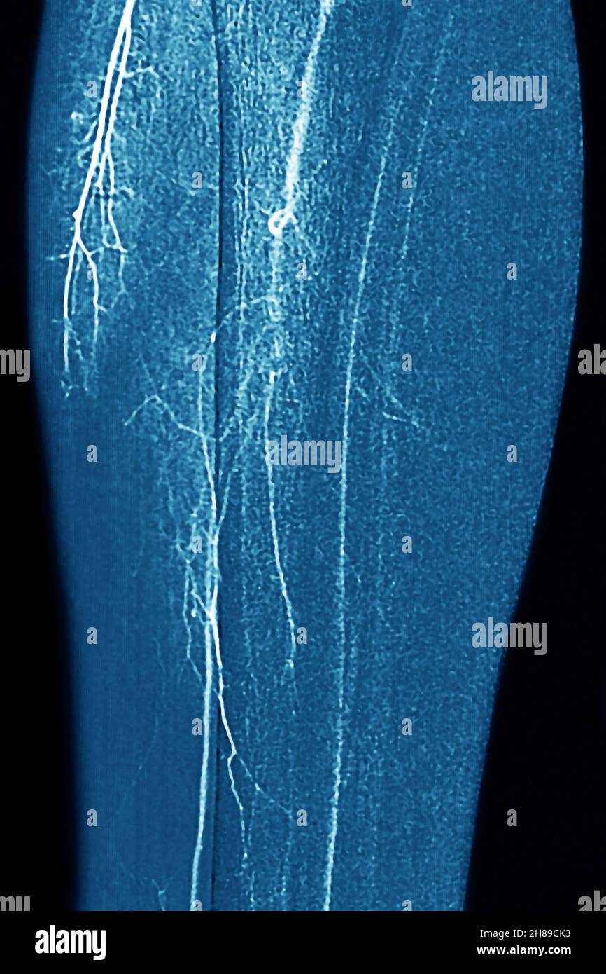 Arteritis of the lower limbs Stock Photo